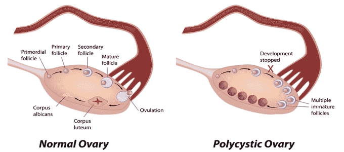 Polycystic Ovarian Disease Treatment