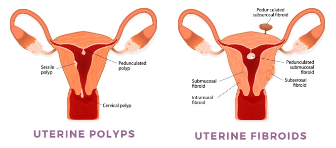 Polyps Treatment