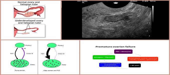 Premature Ovarian Failure Treatment