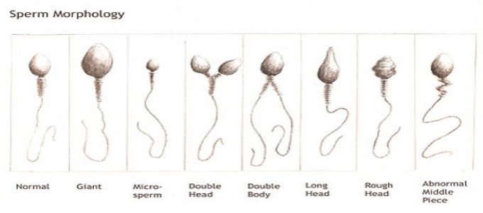 Teratospermia Treatment