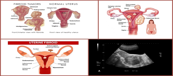 Uterine Fibroids Treatment