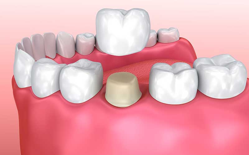 Dental Crown and Bridge Services