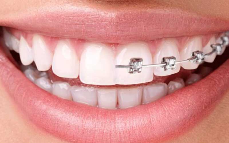 Orthodontic Treatment and Aligner Services