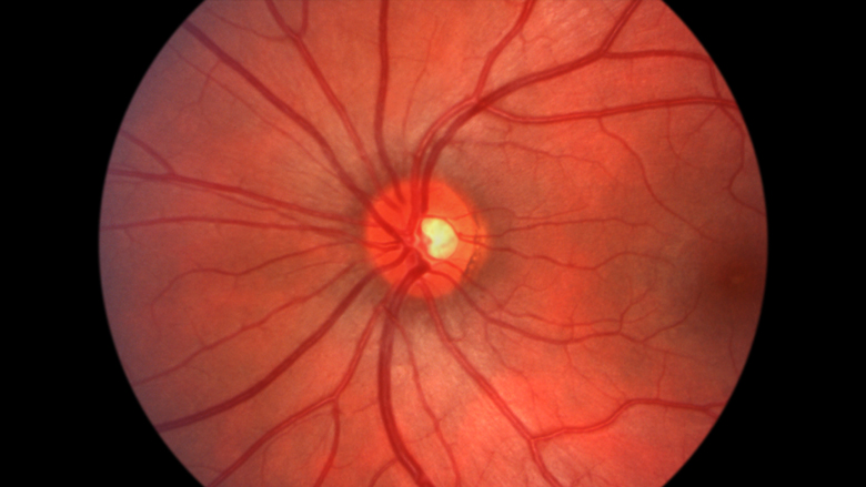 Optic Neuropathy Stem Cell Treatment Services