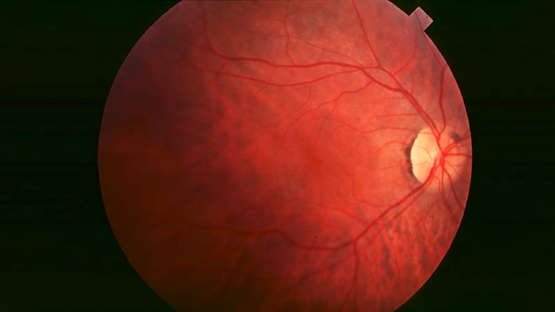 Retinitis Pigmentosa Stem Cell Treatment Services