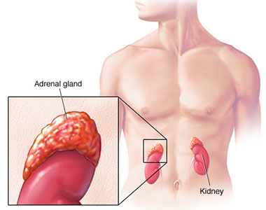 Adrenocortical Carcinoma Treatment (Adult)