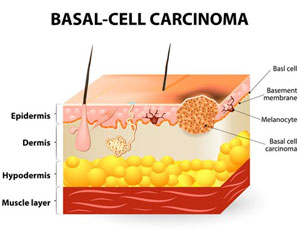 Basal Cell Carcinoma Treatment