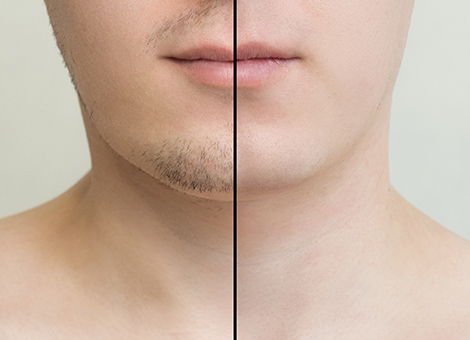 Beard Reshaping Treatment Services