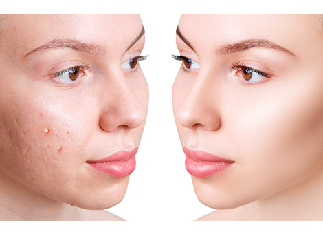 Facial Scars Treatment Services
