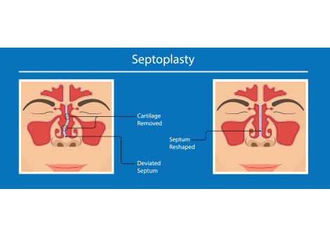 Septoplasty Surgery Treatment Services