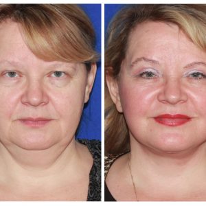 Face Lift Surgery