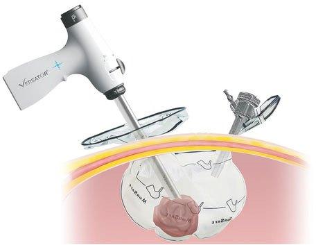 Versator Tissue Morcellator