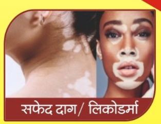 Leucoderma Ayurvedic Treatment