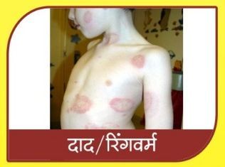Ringworm Ayurvedic Treatment