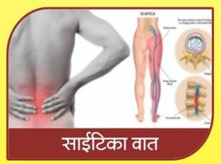 Sciatica Ayurvedic Treatment