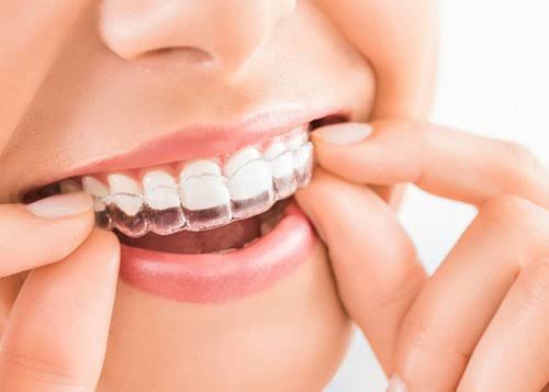 Orthodontic treatments and invisible braces