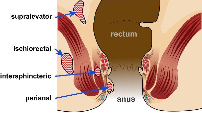 Abscess Pelvic Treatment in India