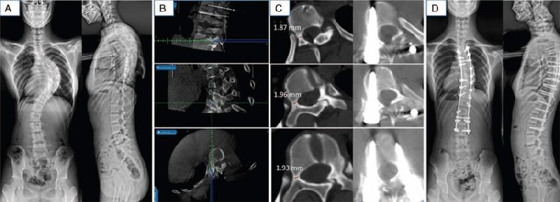 Adolescent Idiopathic Scoliosis Treatment in India