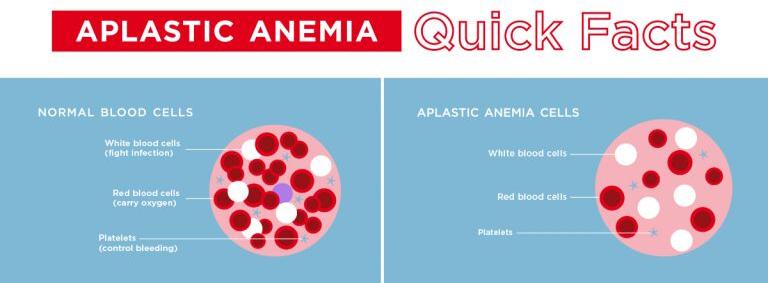 Aplastic Anemia Treatment In India