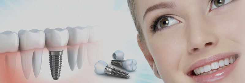 Best Dental Implant Clinic in Delhi NCR