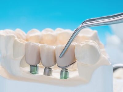 Dental Crown &amp; Bridges Treatment Services