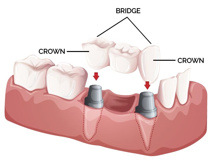 Teeth Crowns Services