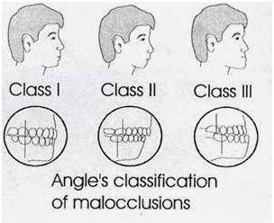 Malocclusion Dental Treatment Services