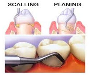 Scaling And Root Planing Treatment Services