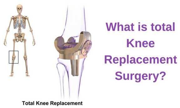 Knee Replacement Surgery