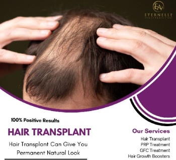 Hair Transplantation