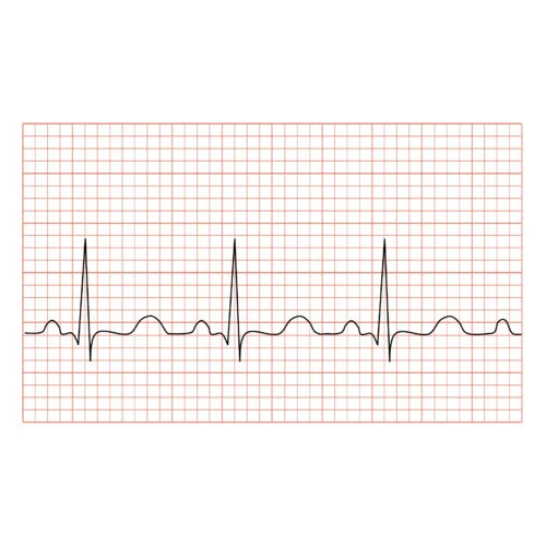 Ecg Chart Paper, For Hospital at Rs 55 / Piece in Jodhpur | Sarthak ...