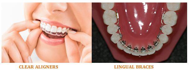 Invisible Braces Treatment Services