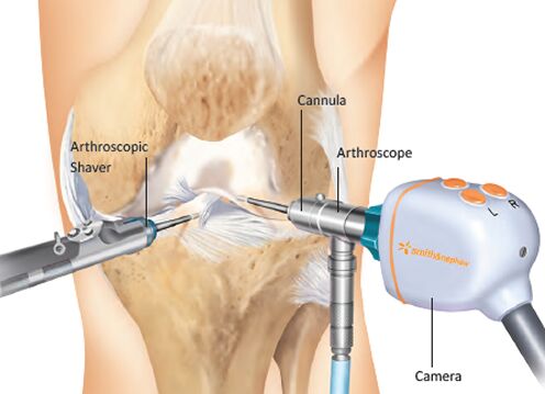 Knee Arthoscopy Treatment