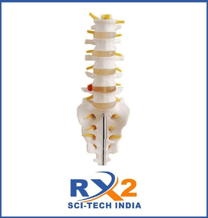 Lumbar Vertearae with sacrum & coccyx and hearinated disc