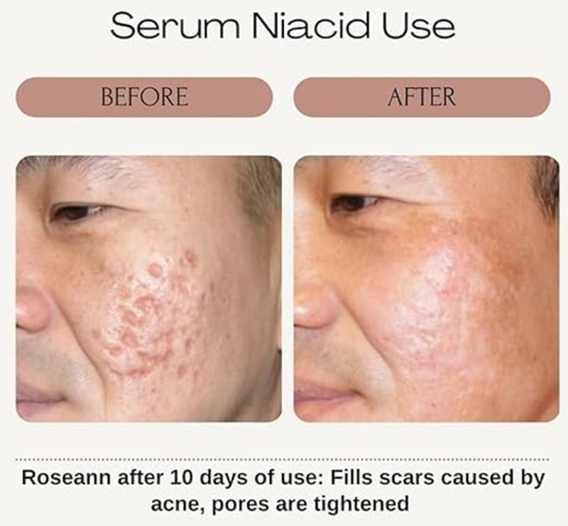 Niacid Face Serum