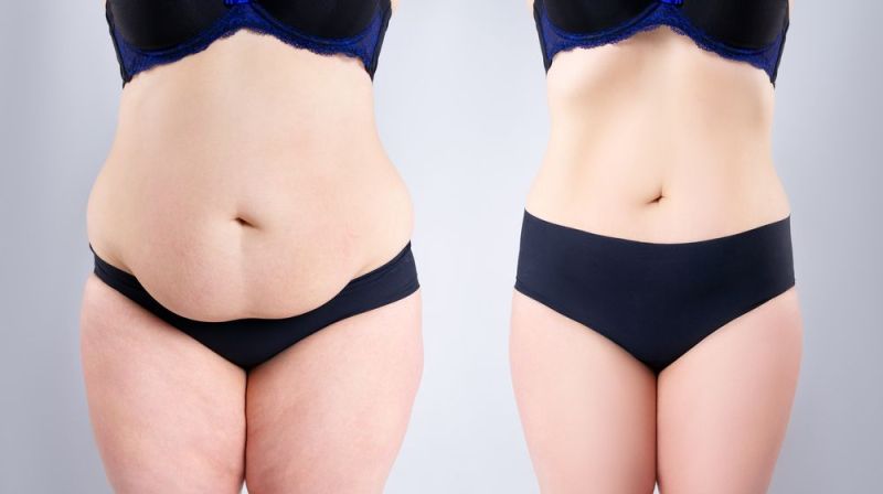 Tummy Tuck Surgery In Ahmedabad