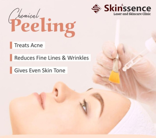 Chemical Peel