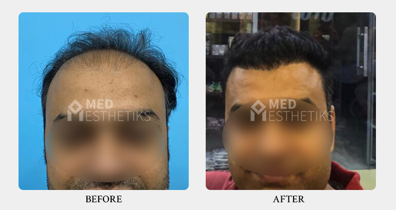 Fue Hair Transplant In Delhi