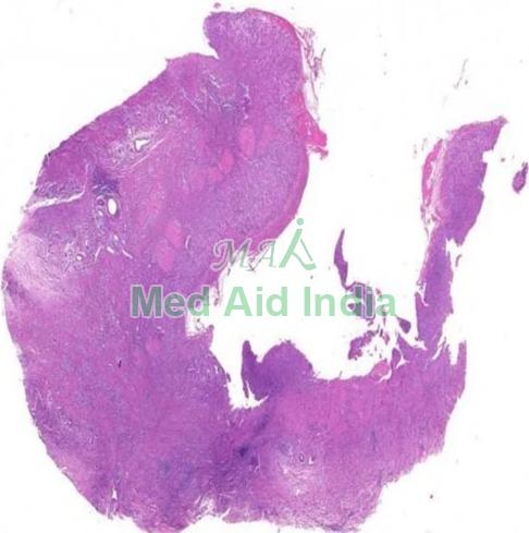 Transparent Carcinoma In Situ Pathology Prepared Slide, for Clinical, Laboratory, Size : Standard