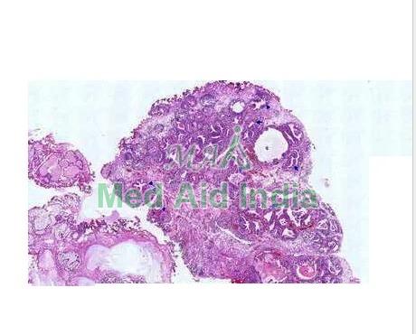 Rectangular Plain Cystitis Glandularis Microscope Slide, for Clinical, Laboratory, Size : Standard