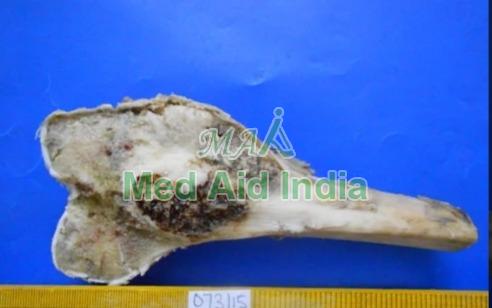 Osteogenic Carcinoma Gross Specimen, for Clinical, Laboratory, Feature : Crack Proof, Eco Friendly