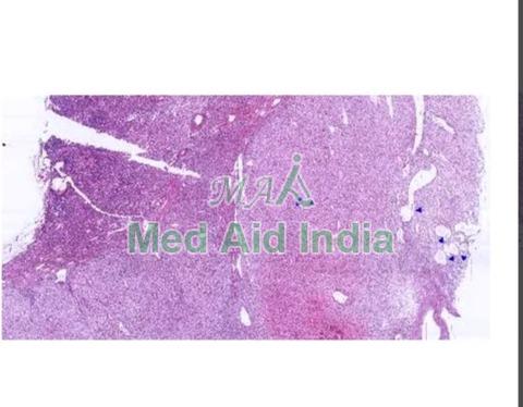 Transparent Rectangular Pathology Clear Cell Renal Cell Carcinoma, for Clinical, Laboratory, Size : Standard