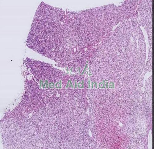 Rectangular Pathology Prepared Slide Renal Cell Carcinoma, For Clinical, Laboratory, Size : Standard