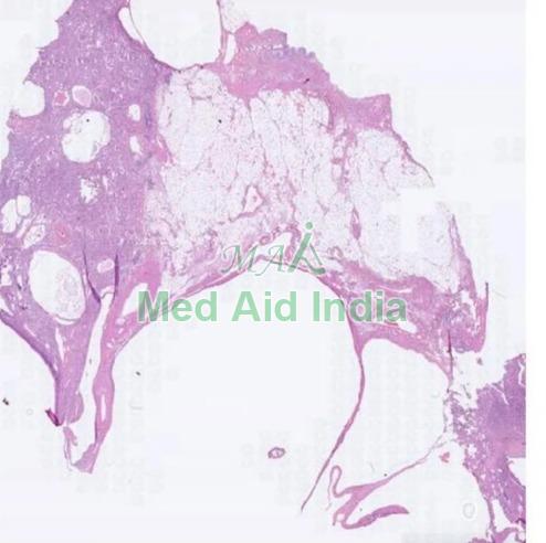 Transparent Rectangular Polycystic Kidney Disease Pathology Slide, for Clinical, Laboratory, Size : Standard