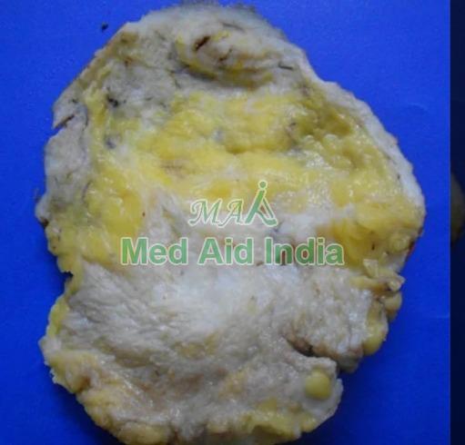 Tuberculosis Breast Gross Pathology Specimen, for Clinical, Laboratory, Size : Standard