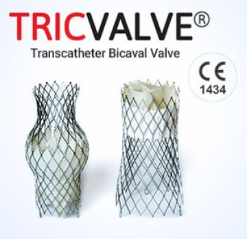 Tricvalve-transcatheter Bicaval Valves System