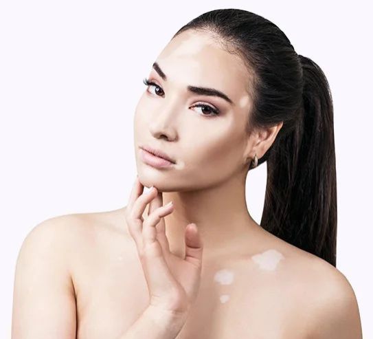 Vitiligo Treatment Service