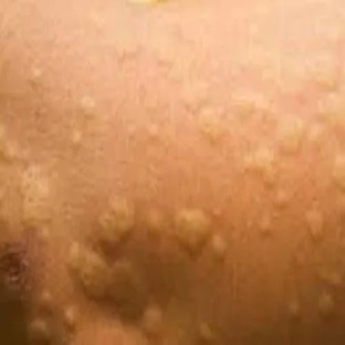 Allergic Sensization Studies Courses