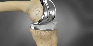 Orthopedic Implant