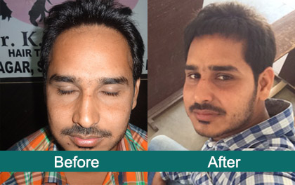 Best Hair Transplant In Surat 2021 | Fue - No Root Touch Surgery | Before  And After 2200+ Grafts - YouTube